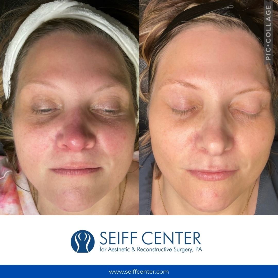 Before & After One Treatment
